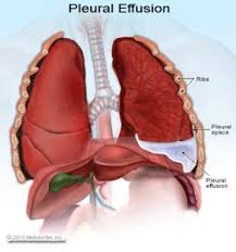 Illustration for article titled Efek Samping Penyakit Paru Paru Basah